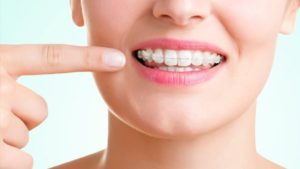 Clear Aligners and Invisible Braces